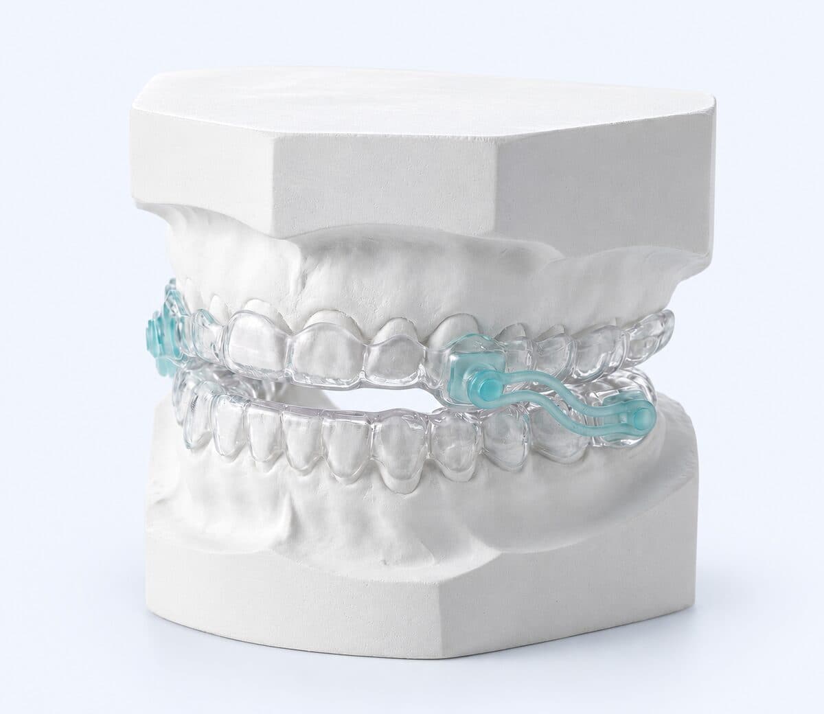 Die fertige Schiene auf dem Gipsmodell des Gebisses im Dentallabor